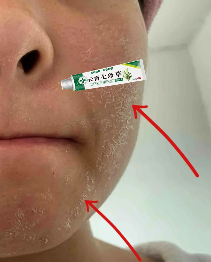 脸部红痒脸干燥痒起皮起痘泛红起疙瘩抑菌止痒膏护理草本
