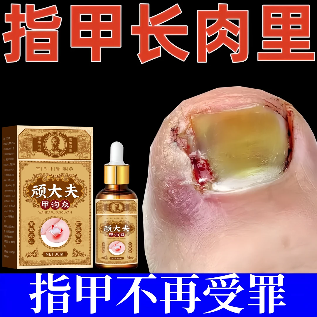顽大夫甲沟软甲指甲长肉里脱甲脚趾甲化嵌甲肉芽脚指头疼甲沟膏