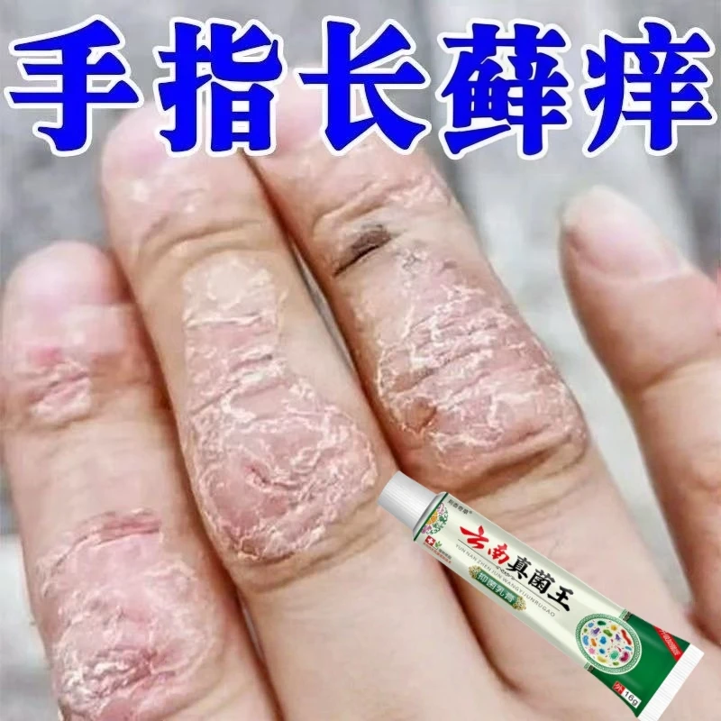 牛皮廯银屑湿痒抑菌草本止痒乳膏手足痒藓起水泡手足裂口子干出血
