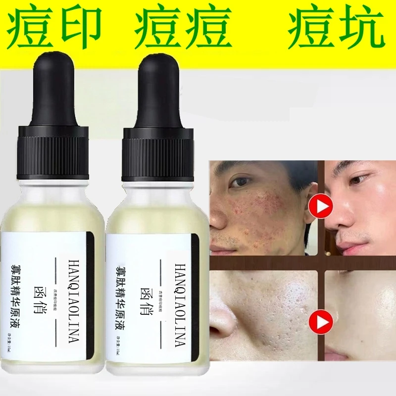 【拍一发二】祛痘寡肽精华原液痘印痘坑修复男女士专用祛痘淡化痘印