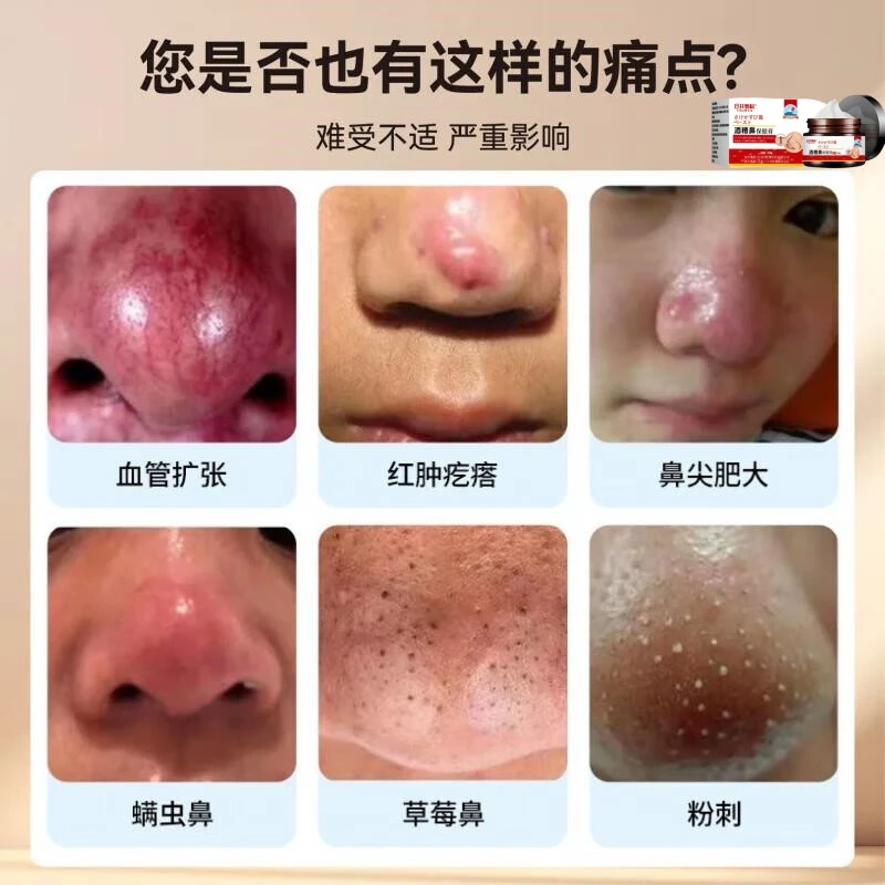 红鼻子鼻头红血丝泛红肿胀黑头粉刺草莓鼻大鼻子温和草本涂抹外用
