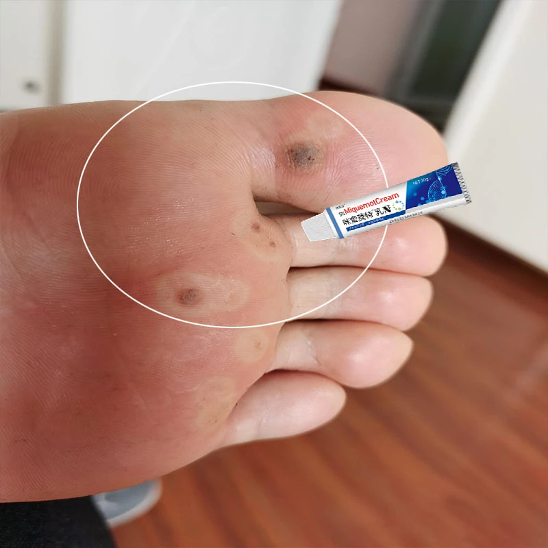 咪喹正品莫特抑菌乳膏用于小肉粒肉钉家用皮肤外用植物草本软膏