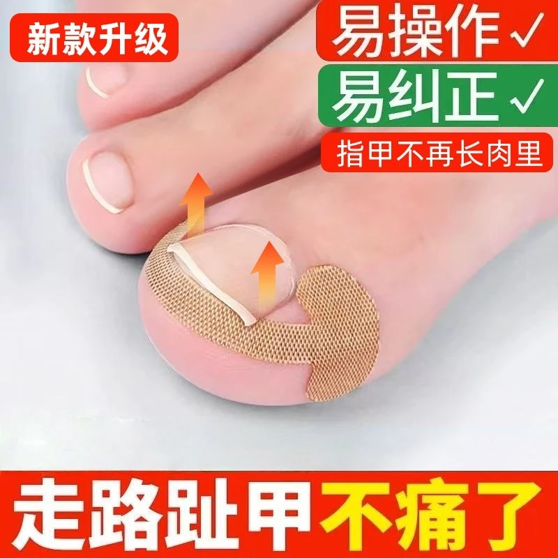 甲沟炎矫正神器嵌甲专用正甲贴片脚趾甲扎肉往肉里长纠正隔离垫片