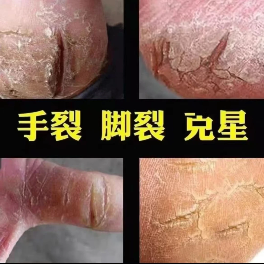 云南真菌王脚后跟开裂专用膏防裂膏手足干裂修复膏保湿粗糙嫩滑