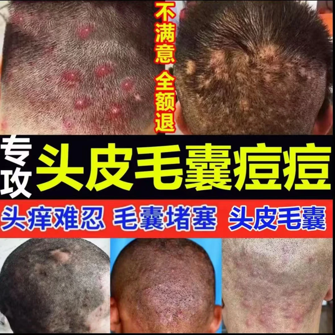 正品毛囊焱背部头皮脓包脸上痘痘痤疮皮肤痒头部胸前疙瘩抑菌止痒