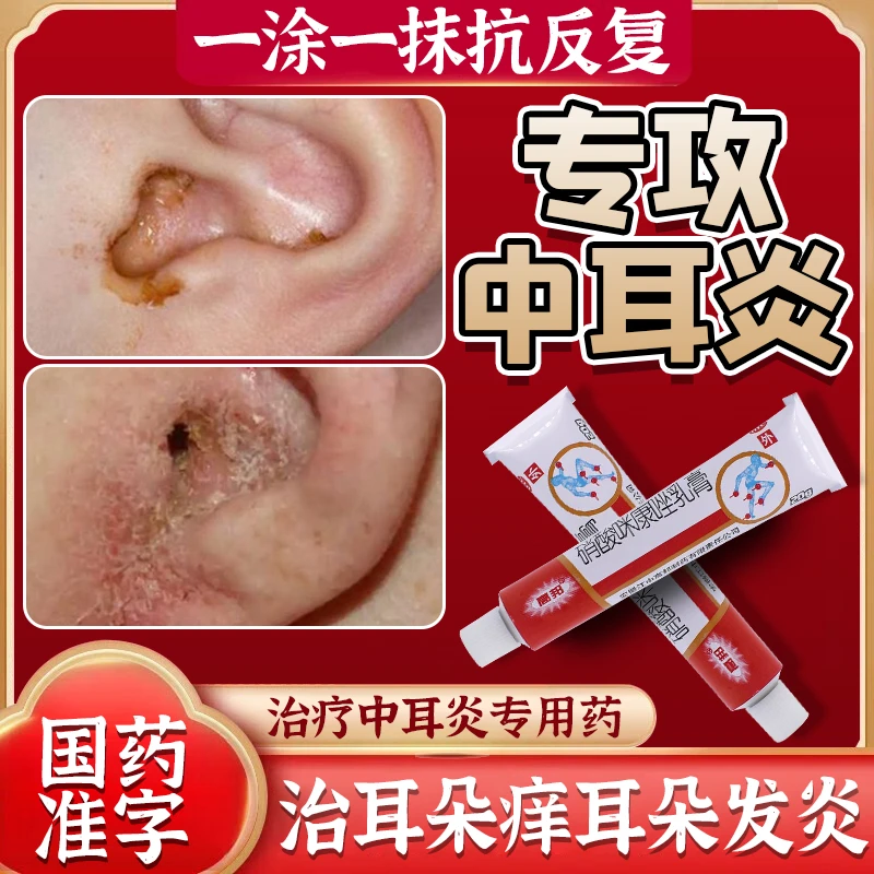 治耳朵痒耳朵发炎流脓药中耳炎 耳聋耳鸣滴耳耳朵嗡嗡响蝉鸣声听力下降 消肿止痛耳内生疮肿痛刺痒高邦硝酸咪康唑乳膏2%*20g