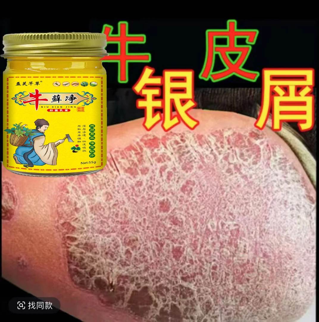 【牛藓净】全身牛皮廯/银屑藓头藓体藓皮焱湿诊止痒膏草本抑菌外用