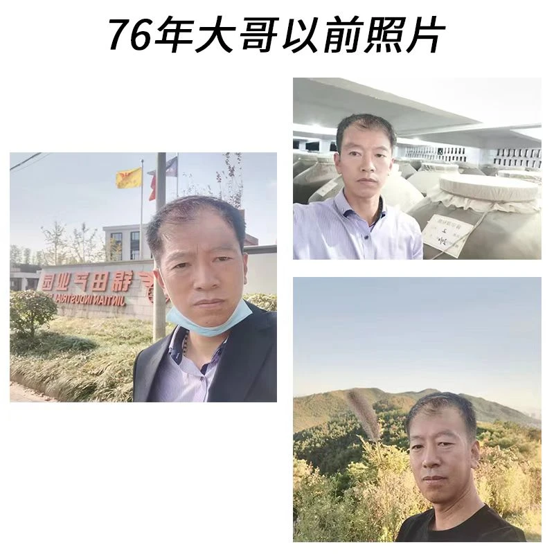 76年大哥以前现在这边对比图 微针
