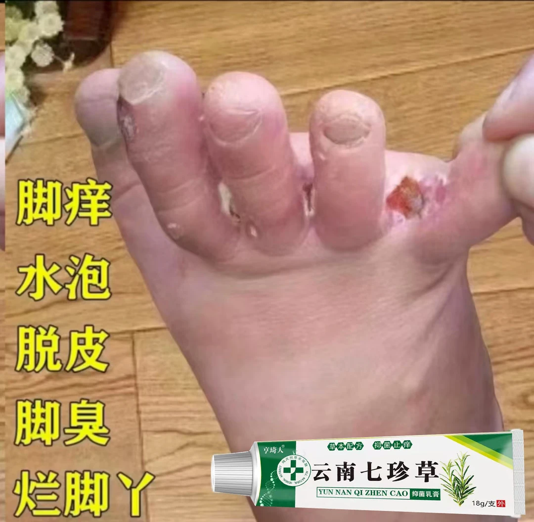 脚趾缝臭痒专用脚痒脚臭止痒膏神器脚丫脱皮抑菌膏开裂克星草本膏