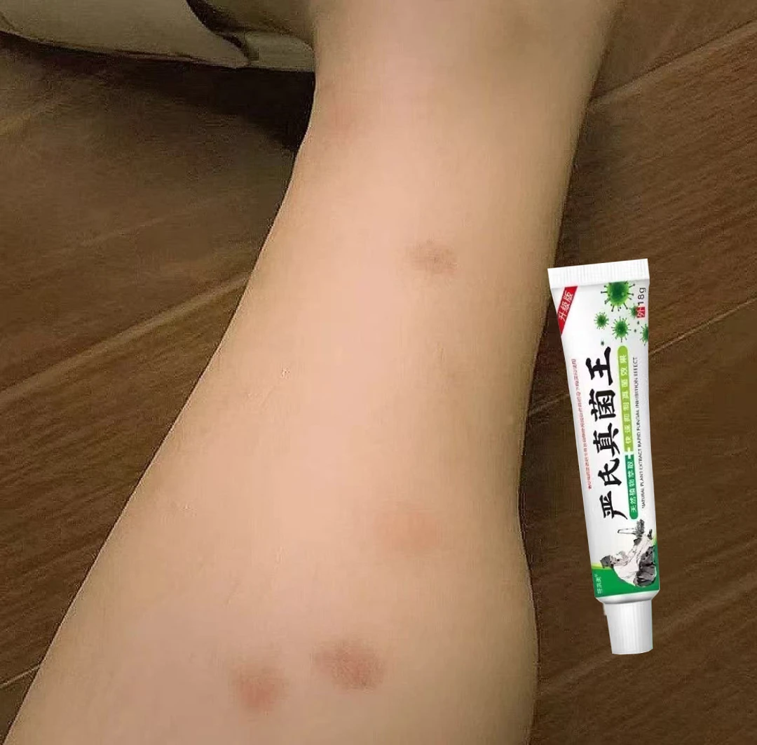 夏季蚊虫叮咬腿上起很多红点点修复咬后留疤黑色素沉积通用抑菌膏