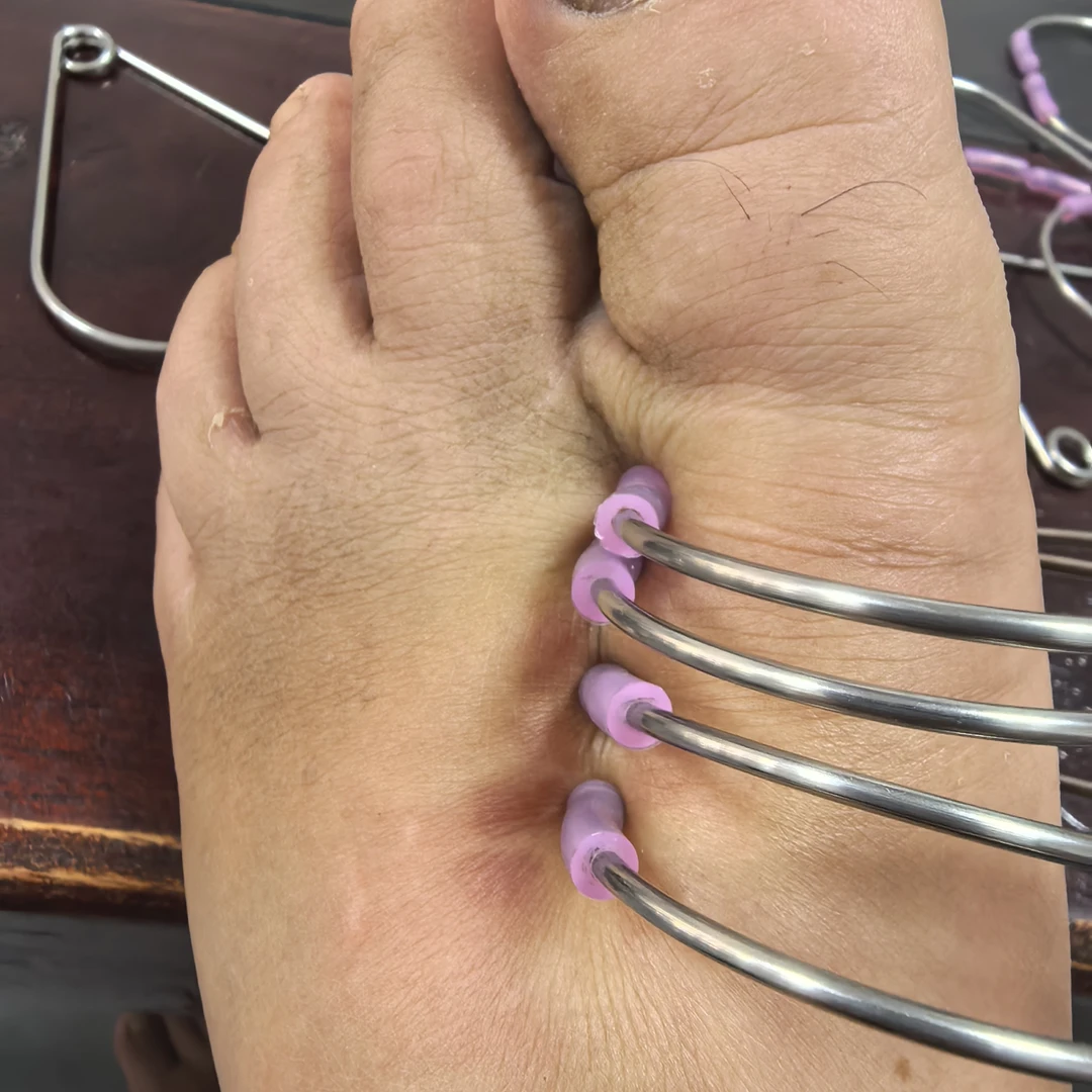 30个一包四肢按摩卡环