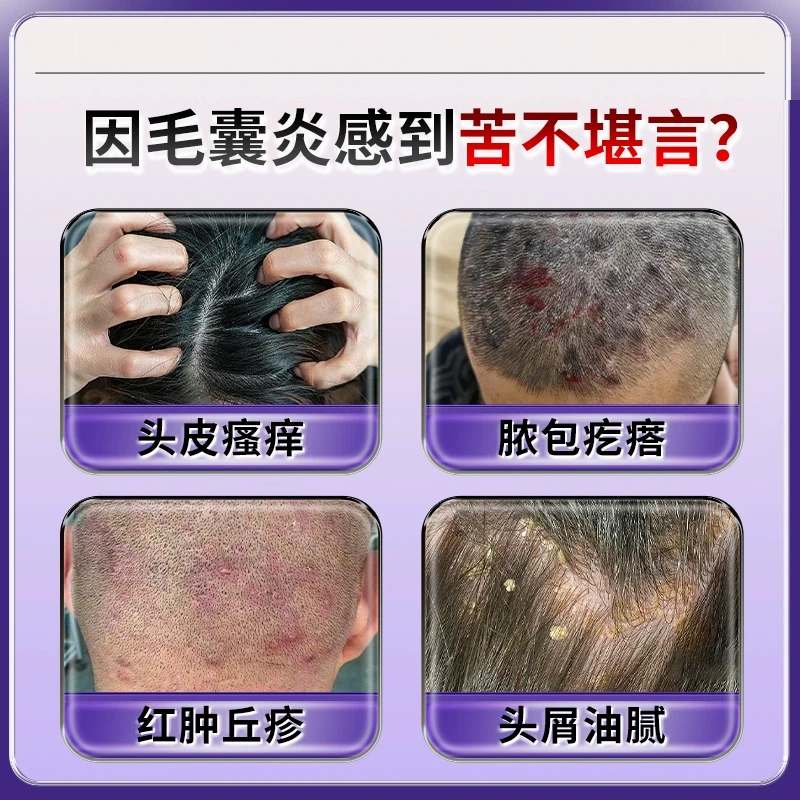 毛囊炎疖肿毛囊瘙痒毛囊红肿细菌性毛囊炎头皮油脂多瘙痒红疹红疙瘩痤疮脓疱药膏曲延康医用重组胶原蛋白头部护理敷料