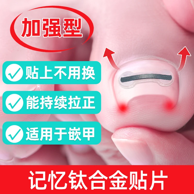 脚医生足部固定器钛合金升级款 嵌甲甲沟炎指甲专用正甲贴