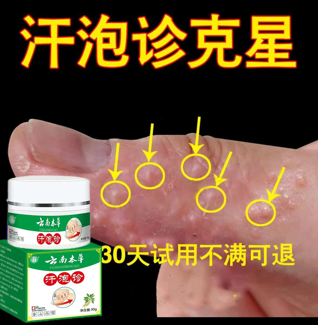 汗泡诊克星手上起小水泡止痒膏脱皮抑菌手指缝痒干裂专用草本乳膏
