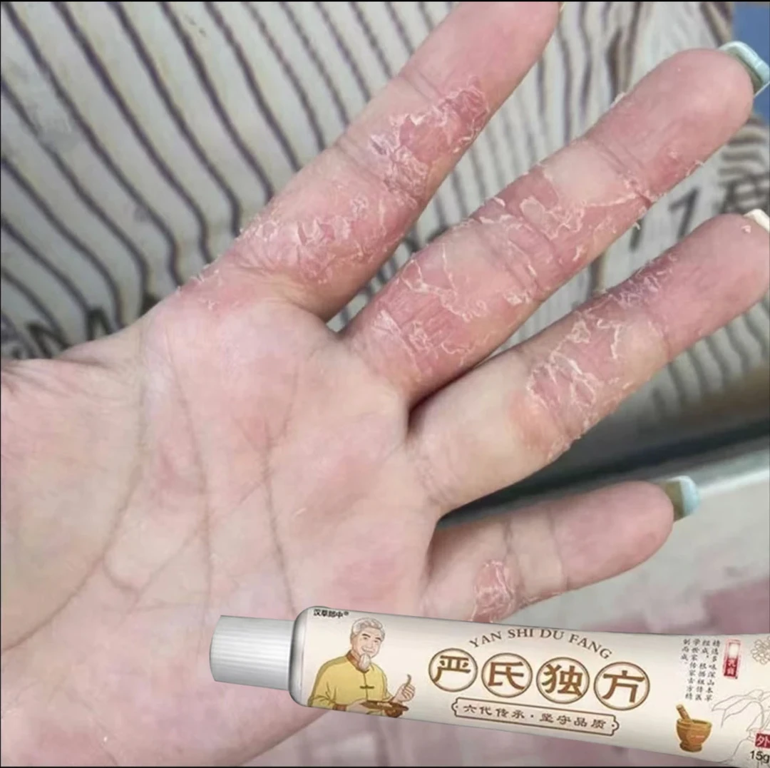 手指脱皮手部痒手足脱皮手指开裂手指起炮手足起汗炮抑菌软膏
