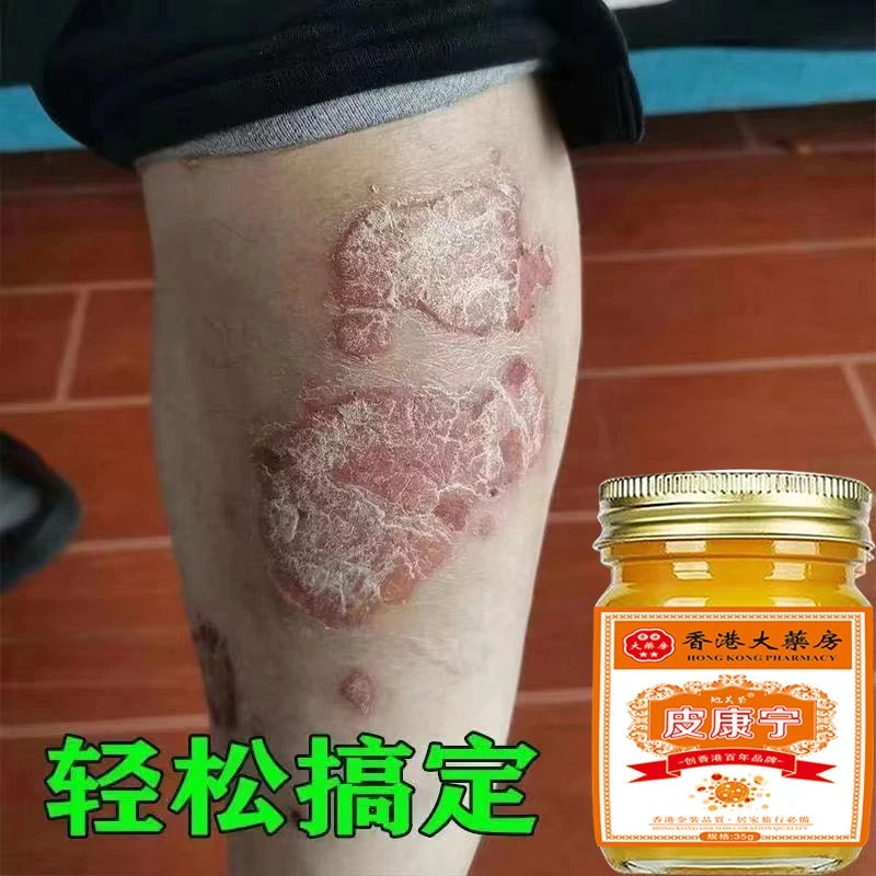 【香港皮康宁】牛皮肤银屑膏头藓顽固手足止痒大腿内侧痒全身可用