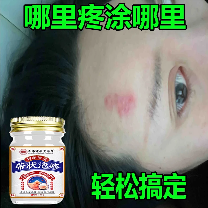 【用了都说好】带状泡疹后遗神经痛蛇盘疮膏带状疱疹后遗症神经痛