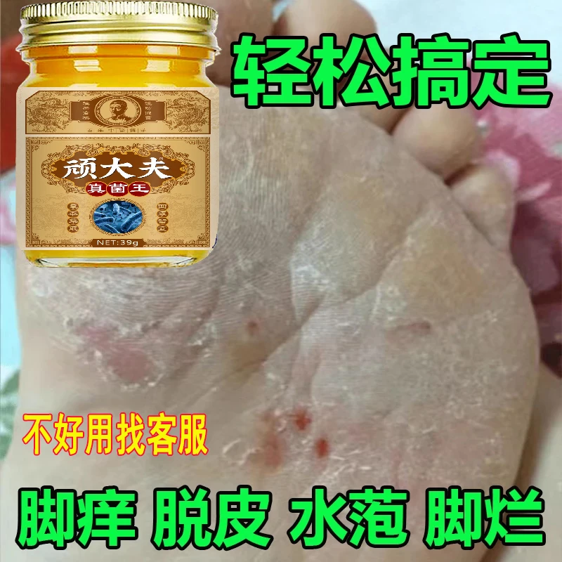 【顽大夫】真菌王脚臭脚痒脱皮起水萢脚后跟干裂趾缝痒草本抑菌抹膏