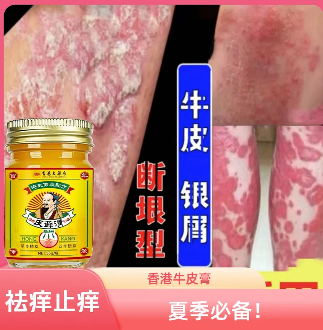 【香港皮鲜清】牛皮廯肤顽固手足体股廯红点止痒大腿内侧痒外用乳膏