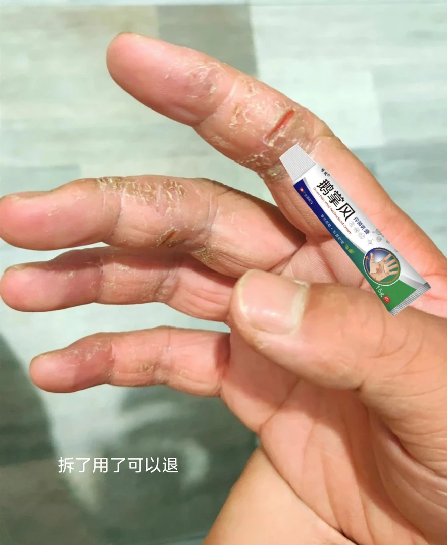 鹅掌风手部干裂脱皮手痒手裂口子手足起泡开口开裂起皮草本抑菌膏
