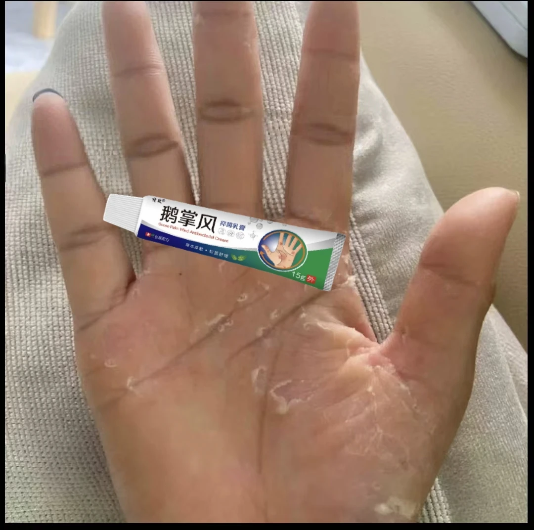 鹅掌风手部干裂脱皮手痒手裂口子手足起泡开口开裂起皮草本抑菌膏