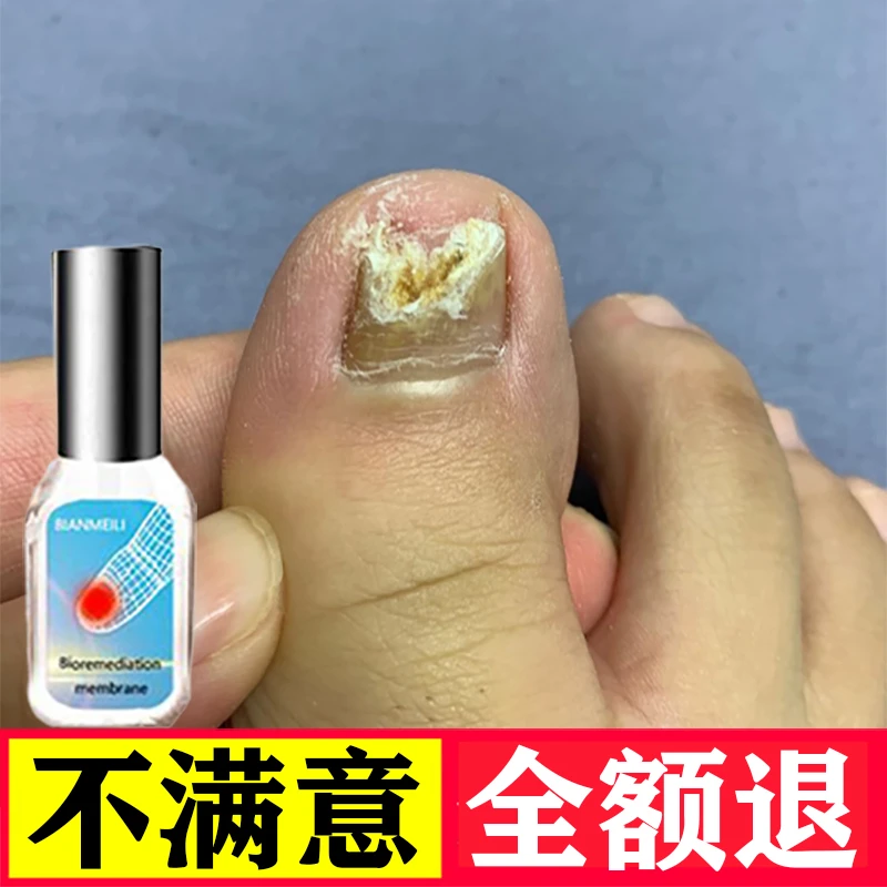 增厚/变空/发黄 手脚指通用涂抹草本精华液