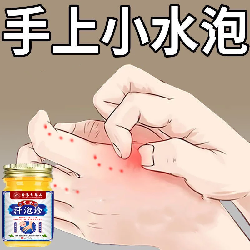 手上起小水泡汗诊泡止痒膏脱皮抑菌克星手指缝痒干裂专用草本乳膏