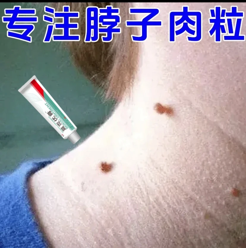 【小肉揪专用】颈部手上腋下小肉揪身上真难看神器