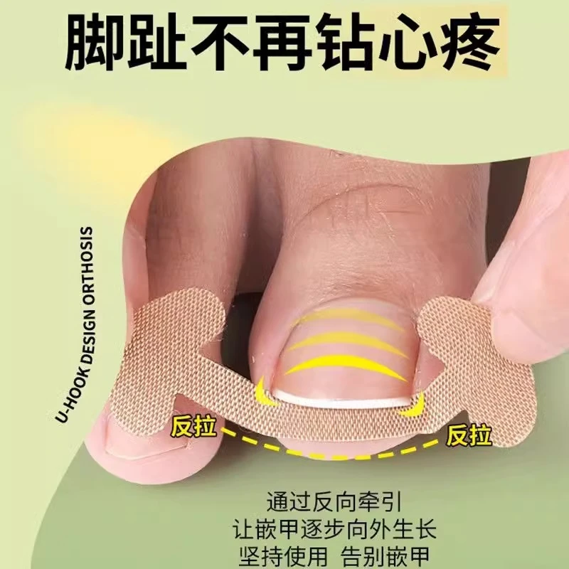 甲沟矫正器嵌甲往肉里长专用隔离贴片纠正脚趾甲填充垫正甲贴炎