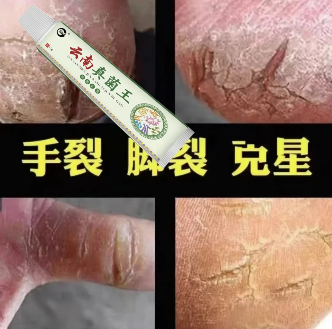 脚后跟干裂粗糙脚底起皮脚痒脚后跟脱皮脚臭抑菌止痒软膏