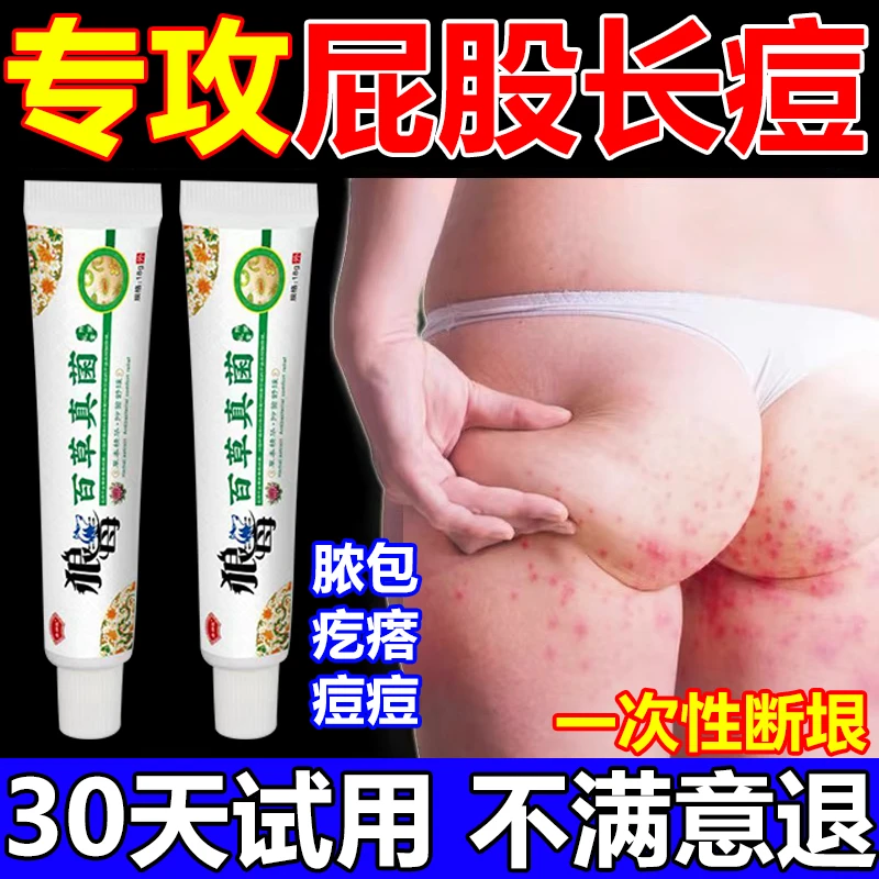 屁股长痘痘疙瘩脓包火节子湿痒止痒抑菌专用膏久坐痤长痘去除神器
