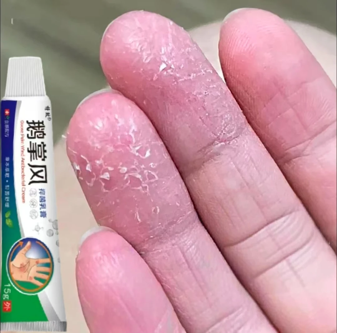 鹅掌风手部干裂脱皮手痒手裂口子手足起泡开口开裂起皮草本抑菌膏