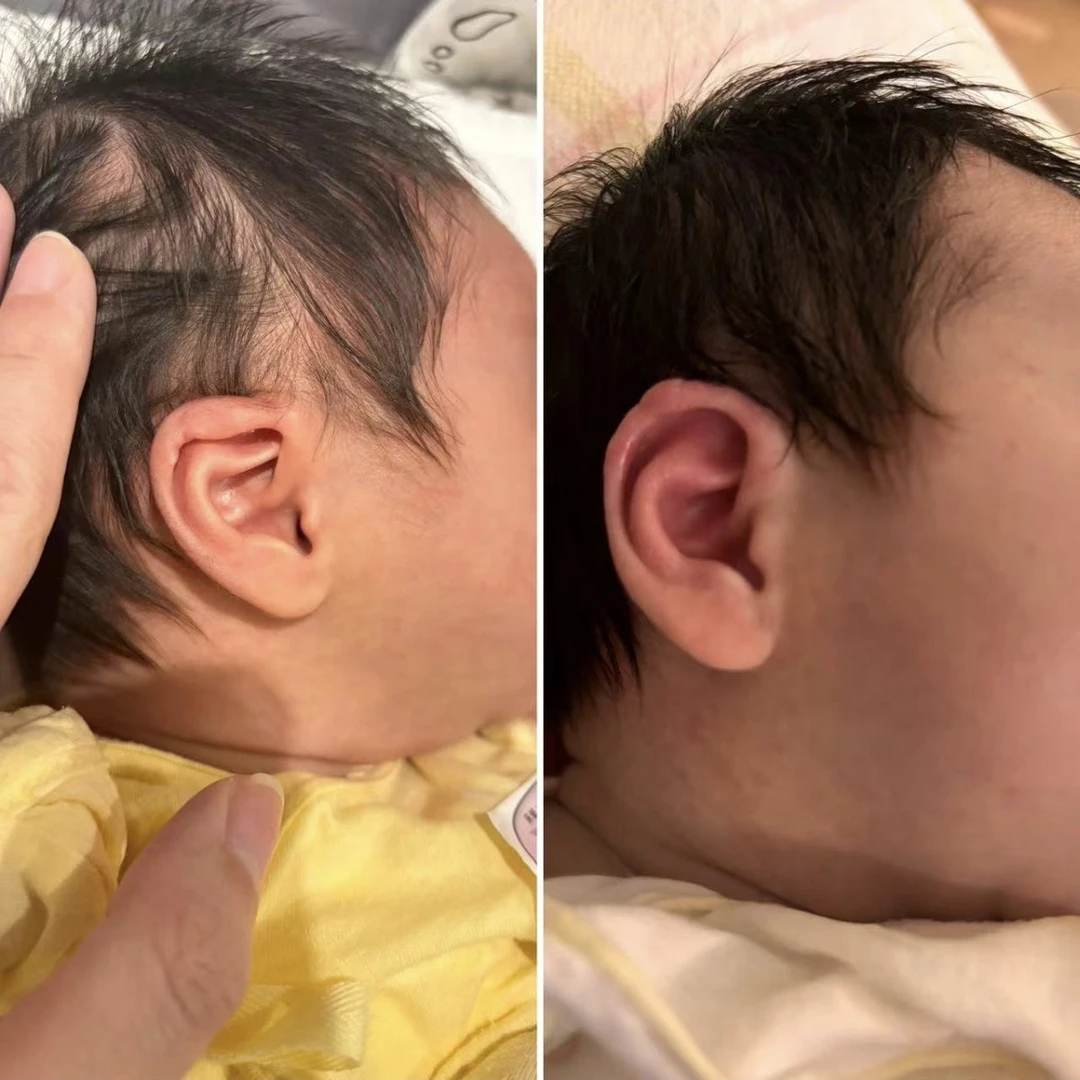 耳朵支撑辅助婴儿新生儿耳廓硅胶耳撑垂耳招风耳耳夹固定定型神器