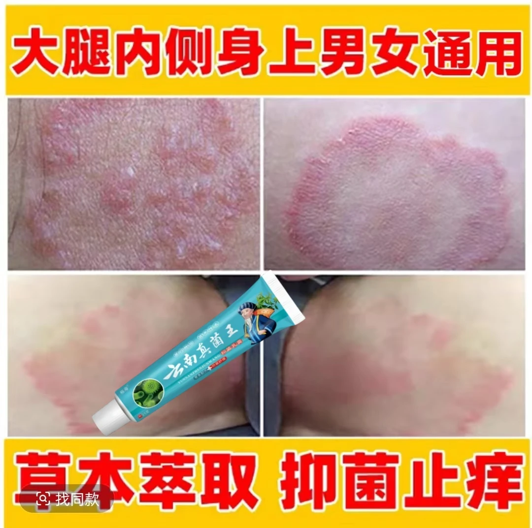 大腿内侧瘙痒越抓越痒大腿和睾丸夹缝处潮湿异味外用止痒抑菌软膏