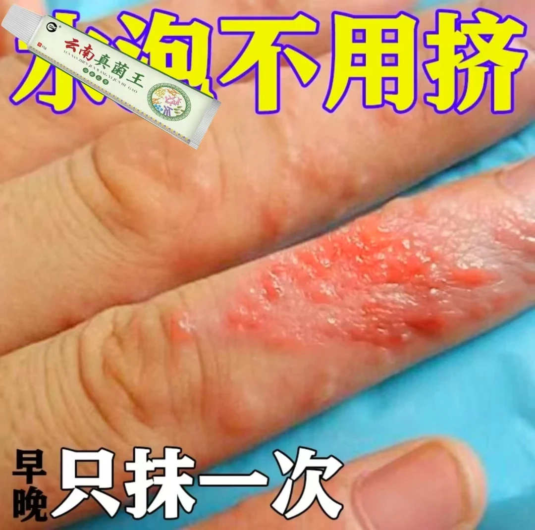 抗菌软膏真菌感染手痒膏小水泡手心痒小疙瘩大腿痒