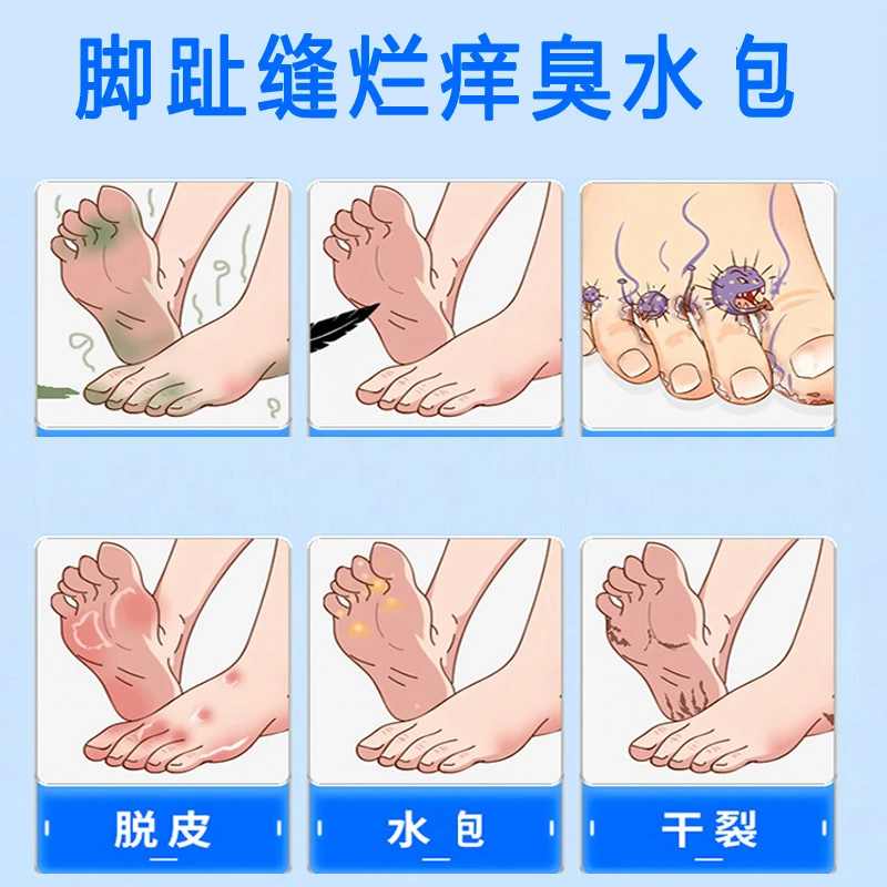 脚趾缝痒脚臭止痒克星脚出汗脱皮起小水泡干裂足部专用喷剂神器