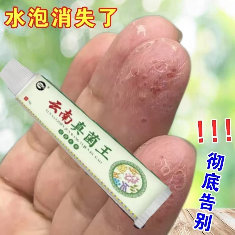 云南真菌王软膏应对手足·脱皮脚心痒小水泡 困扰去除脚臭抑菌止痒