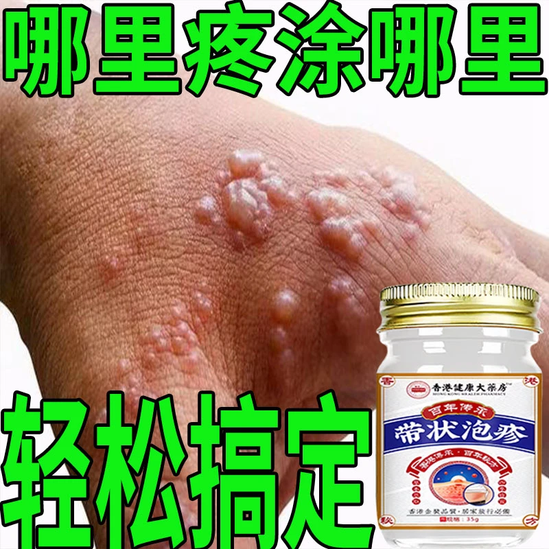 带状泡疹后遗神经痛蛇盘疮膏蛇盘清宝带状疱疹后遗症神经痛特效药
