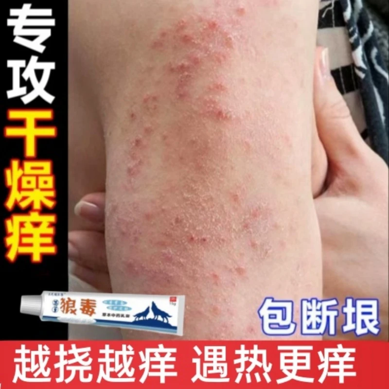 冬天腿上手臂大腿皮肤干燥发痒越抓越痒起皮屑小红疙瘩止痒抑菌膏