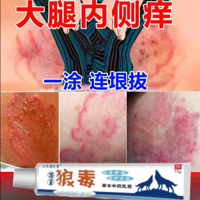 大腿内侧痒股大腿内侧痒发黑脱皮干燥痒摩擦抑菌软膏
