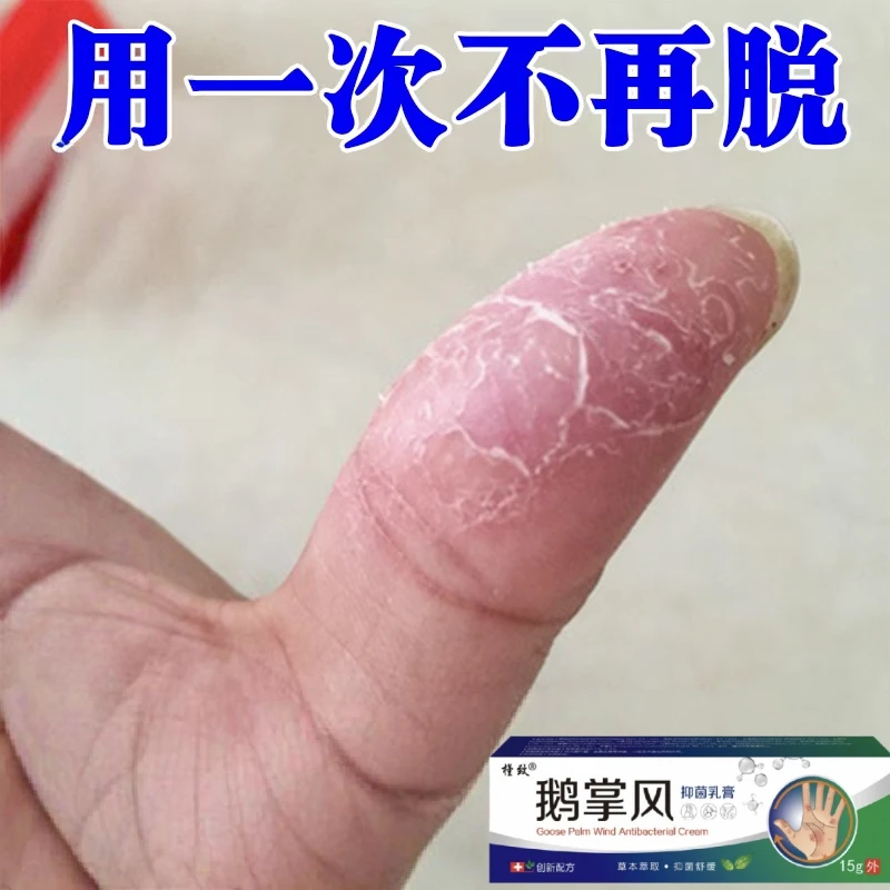 鹅掌风手部干裂脱皮手痒手裂口子手足起泡开口开裂起皮草本抑菌膏