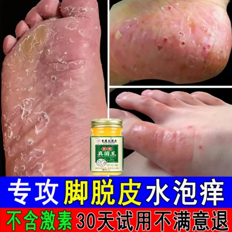 脚底趾缝干裂脚痒脚臭克星止痒软膏神器脚脱皮真菌特效专用膏