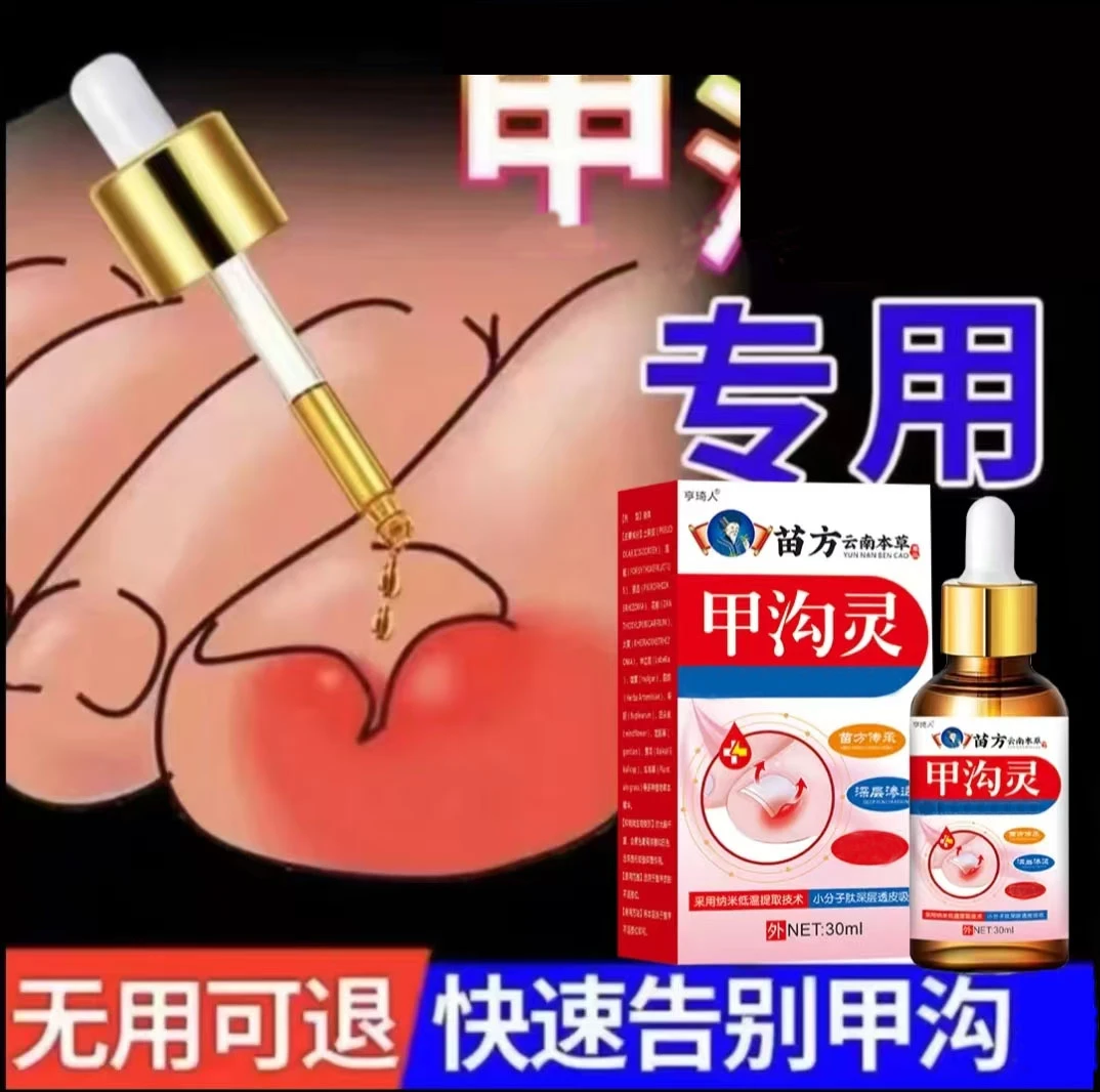 指甲长肉里脚趾脓嵌甲肉芽脚指头疼甲沟膏 身体