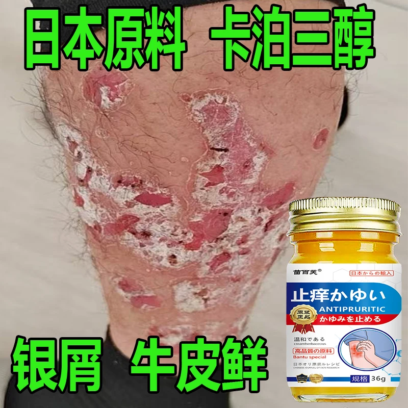 【日本配方】牛皮肤银屑膏头藓顽固手足止痒大腿内侧痒全身可用