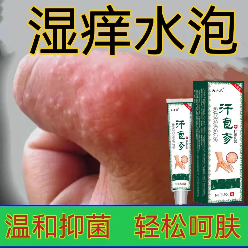 汗疹克星手上起小水泡止痒膏脱皮抑菌手指缝痒干裂专用草本乳膏