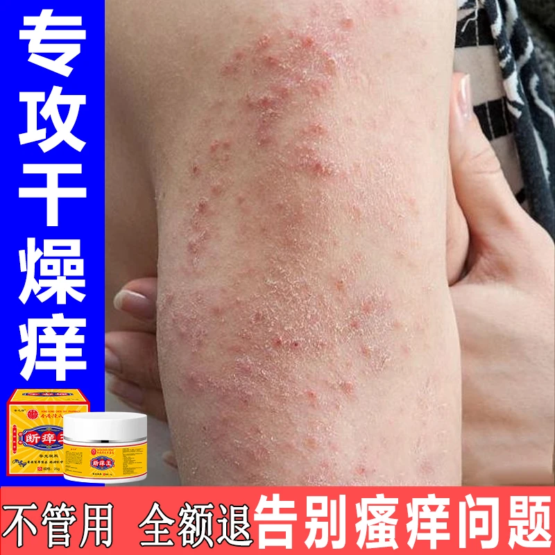 冬天腿上手臂大腿皮肤干燥发痒越抓越痒起皮屑小红疙瘩抑菌止痒膏