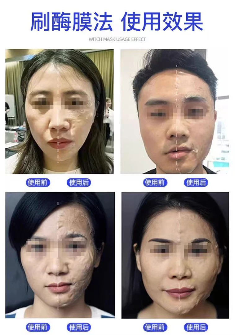【幼肽酶】美人骨刷酶主攻法令纹松弛皱纹院线王牌抗衰项目