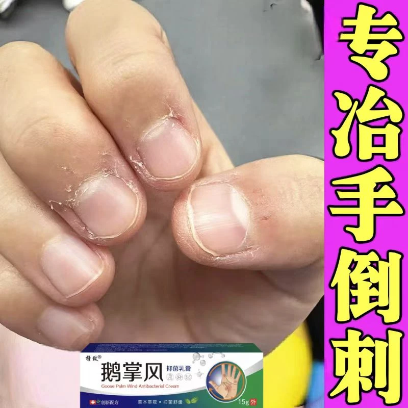 手指头褪皮指甲边缘起倒刺脱皮严重掉皮手脱皮手上起皮干燥抑菌膏