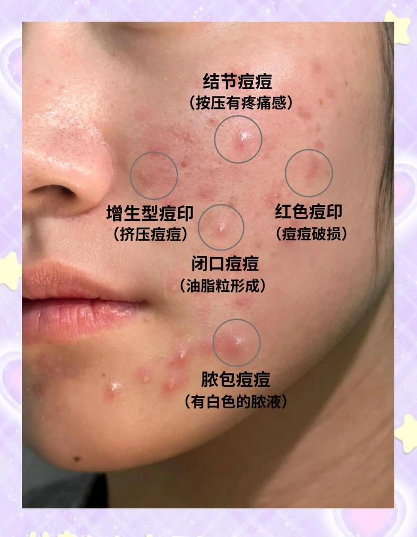 祛痘膏淡化痘印痘坑去黑头闭口控油收缩毛孔温和不刺激