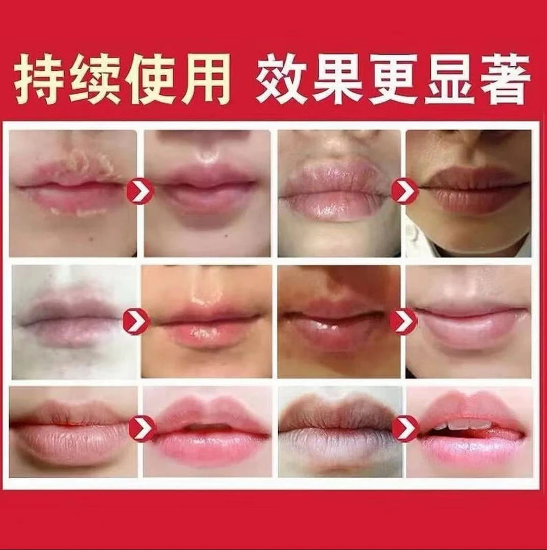 唇炎膏专用修复嘴唇口周干裂脱皮红痒上火烂嘴角开裂保湿滋润唇膏